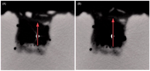Figure 9. CT images obtained during a 60 W MW ablation procedure performed on 30-mm ex vivo bovine liver cubes (less reflective) submerged in agar phantom (more reflective). A section orthogonal to the antenna axis at the antenna feed point is represented. The white dot in the middle is the 14-gauge antenna (A) prior to the heat-treatment; (B) after 1.5 min of heating. From the figure the expansion phenomenon is evident. On top of the tissue cube the agar phantom shows a poor contrast due to the presence of the added saline solution (see Materials and methods section).