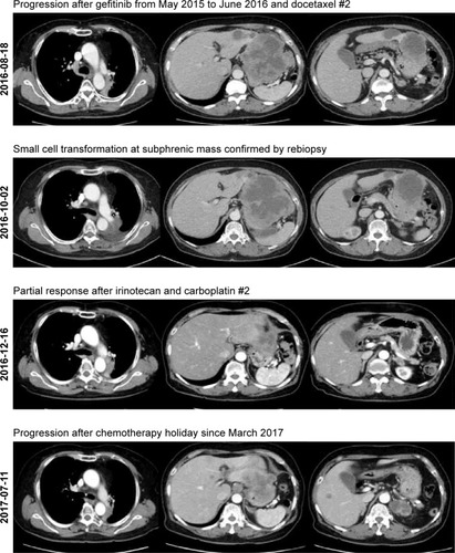 Figure 2 Computed tomography (CT) images showing treatment-related changes.