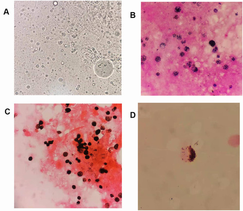 Figure 1 Direct microscopic morphology of skin tissue and CSF. (A) Direct wet film microscopy of skin tissue, 400×. (B) Gram stain of skin tissue, 1000×. (C) GMS of skin tissue, 1000×. (D) GMS of CSF after centrifugation, 1000×.