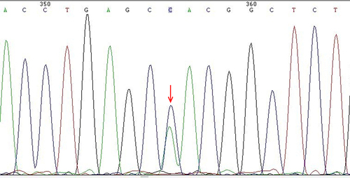 Figure 2 Sanger sequencing peak of HBA2 gene in patients with Hb Guiyang.