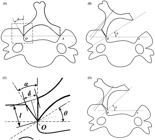 Figure 1. (A) The process of creating bone gutters during laminoplasty. (B) EL simulation with an elevated lamina angle of θ. (C) Radiological parameters and their geometric relationship in the bone gutter of EL. (D) EL simulation with an inappropriate bone gutter width. In this case, insufficient width of the bone gutter results in splitting of the gutter.