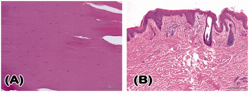 Figure 7. Histopathological examination of a vastus lateralis muscle specimen from Case 2’s paralytic lower limb revealed denervation muscle fiber atrophy with striation loss and collagen fiber accumulation (H&E 200×) (A). Histological sections of paralytic thigh skin showed the presence of chronic perivascular inflammatory cell infiltration and fibrosis. (H&E 100×) (B). H&E: haematoxylin and eosin.
