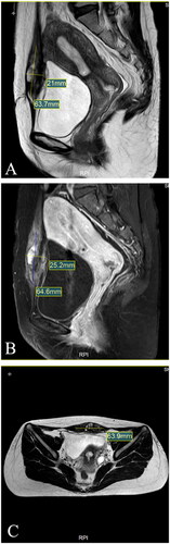 Figure 2. MRI for patient before HIFU (Aug. 22nd, 2020). (A) Sagittal T2-weighted image showed the mass’s size is 63.7 × 21.0 mm; (B) Post-contrast sagittal T1-weighted image showed the mass’s size is 64.6 × 25.2 mm; (C) Axial T2-weighted image showed the mass’s size is 63.9 mm.