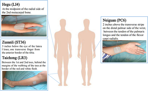 Figure 1 Location of Acupoints: from left to right: Hegu (LI4), Zusanli (ST36), Taichong (LR3), Neiguan (PC6).