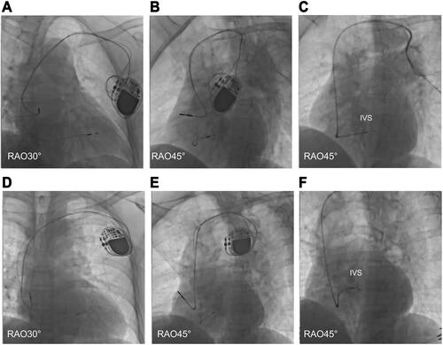 Figure 3 Postoperative images of LBBaP (A and B) and RVSP (D and E), contrast injection through the sheath in LBBaP (C) and RVSP (F).