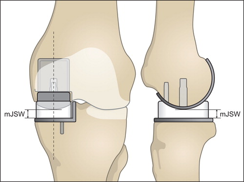 Figure 3. The frontal view to the left outlines the measurement of the minimal joint space width (mJSW). The dotted line represents the sagittal cross-sectional view presented to the right. The mJSW reflects the bearing thickness and the projected dotted line on the tibial component represents the femorotibial contact point. This allows the estimation of PE wear and the position of the bearing. Overhang is seen when the bearing exceeds the outline of the tibial plateau. Impingement can be identified if the bearing slides against the vertical wall (see frontal view).