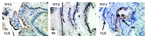 Figure 5. Expression of TFF2 and TFF3 in human columnar-lined epithelium (CLE) and intestinal metaplasia (IM). TFF2 marks an early precursor cell in the columnar lineage; staining is seen in CLE, but (B) with the development of IM, TFF2 staining decreases. (C) Conversely, TFF3 staining is not seen in CLE but increases with the development of IM.