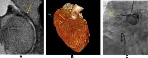 Figure 5 Female patient, 50 y old, hypertensive with hyperlipidemia, complains of atypical chest pain associated with dyspnea with ST-segment depression on ECG findings and negative cardiac enzymes. (A) CPR image of RCA; Shows occluded segment at the proximal segment of 22.2 mm length with faint distal retrograde filling (Yellow arrow). (B) VR 3D reconstruction demonstrates RCA; Shows proximal RCA segment total occlusion with distal retrograde filling (Yellow arrow). (C) ICA image (LAO view); Confirms proximal RCA total occlusion (Yellow arrow). Diagnosis CAD RADS 5.