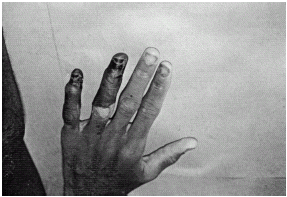 Figure 3. Show gangrene of the digits.