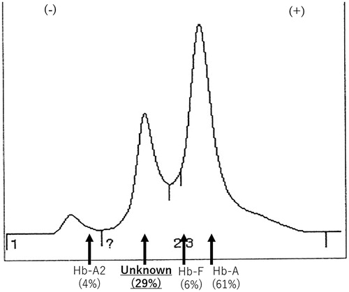 Figure 2. The Hb A1c analysis by the HPLC method. The Hb A2 level was 4.0%, the estimated ratio of the unknown Hb was 29.0%, Hb F value was 6.0% and Hb A 61.0%.