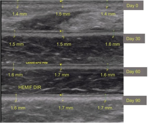 Figure 6 Ultrasound images of the malar region (in detail) in patient 1.