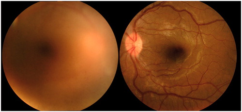 Figure 1. Fundus photographs of both eyes at presentation: (A) right eye; (B) left eye. Intensive vitreous opacities in the right eye obscure fundus observation, thus retinal vasculitis was not detectable.