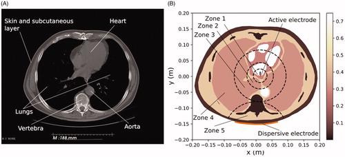 Figure 2. (A) Cross-section of a CT medical image which was segmented to identify zones associated with the different tissue types (image retrieved from [Citation19], ID 71813). (B) Model geometry resulting from the previous segmentation (scale represents electrical conductivity in S/m).