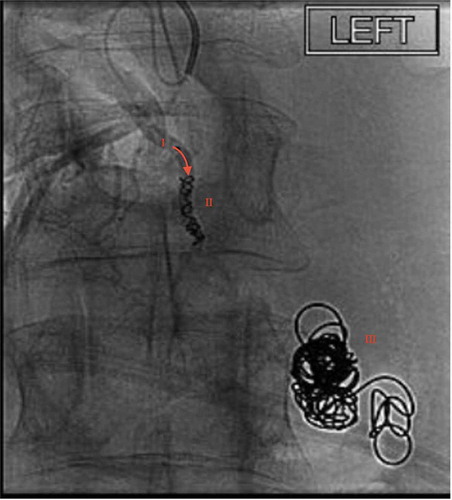 Figure 3. Fluoroscopy demonstrating successful microcoil placement in a medial branch of the superior mesenteric vein feeding the ectopic varix. Annotations as follows: I: medial branch of superior mesenteric vein, II: microcoil placement obstructing DEV afferent vein, III: previously deployed 0.35 interlock coil