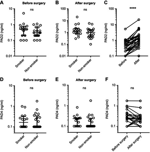 Figure 1 Circulating PAD2 and PAD4 levels before and after CABG surgery. Circulating levels of PAD2 and PAD4 were assessed in 16 smokers and 20 non-smokers before and after CABG surgery. (A) Serum PAD2 concentration before surgery. (B) Serum PAD2 concentration after surgery. (C) Serum PAD2 concentration of all patients before and after CABG. (D) Serum PAD4 concentration before surgery. (E) Serum PAD4 concentration after surgery. (F) Serum PAD4 concentration of all patients before and after CABG. Levels below the lower limit of detection of the two tests (100 pg/mL) were set to 100 pg/mL. ****p<0.0001.Abbreviations: ns, not significant; PAD, peptidylarginine deiminase; CABG, coronary artery bypass grafting.