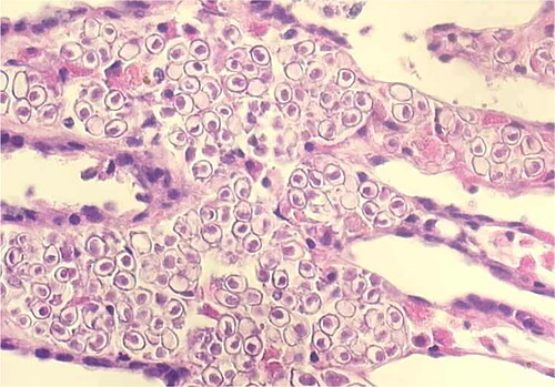 Figure 8. Histological section of advanced infection with the haplosporidian Haplosporidium raabei in gill of Dreissena polymorpha (adapted from Molloy et al. Citation2012).