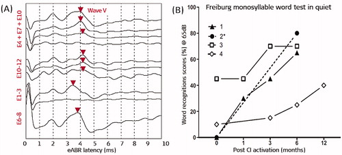 Figure 35. eABR responses from the dissected cochlea with electric stimulation from the special electrode array (A). Freiburg monosyllable word test scores of patients implanted with special electrode array showing improvement in hearing performance (B) [Citation29]. Image courtesy of Prof. Stefan Plontke, Halle, Germany.