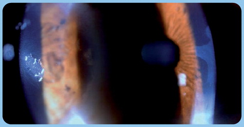Figure 4. Nonhealing corneal epithelial defect in severe dry eye before and after amniotic membrane transplantation.