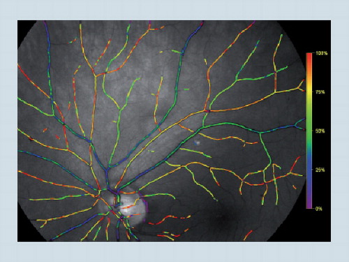 Figure 3. Color overlay of oxygen saturation in the retinal vessels.Color figure can be found online at www.expert-reviews.com/doi/full/10.1586/eop.12.41