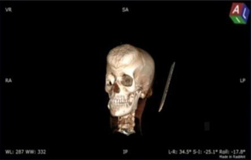 Figure 4 Left lateral view of the CT scan of the head with 3D reconstruction showing the bifrontal mass.