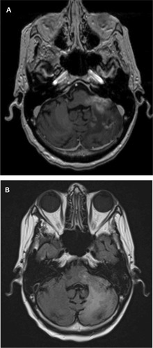 Figure 2 (A) An axial T1-weighted postgadolinium contrast-enhanced magnetic resonance image of the same patient after bevacizumab treatment reveals a significant reduction in the size and shape of the cerebellar/brainstem contrast enhancing tumor. There is also a decrease in the adjacent mass effect with opening up of the adjacent fourth ventricle. (B) An axial fluid attenuated inversion recovery image of the patient after bevacizumab treatment reveals a significant reduction in the hyperintensity of the cerebellar and brainstem involvement. This is associated with a decrease in the adjacent mass effect and opening up of the sulci and adjacent fourth ventricle.