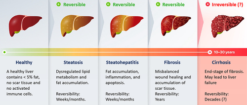 Figure 1. Fatty liver starts off as simple steatosis, which further can trigger inflammation and damage of the liver cells, potentially resulting in fibrosis of the liver. Further progression of the disease may lead to the end-stage of irreversible liver cirrhosis.