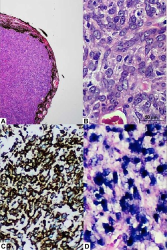 Figure 3 Histopathology and Immunohistochemical stain.
