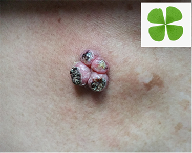 Figure 1 Four red nodules of different sizes, from 4 mm×3 mm to 10 mm×6 mm, were seen on the right chest, with a crater-like horn plug in the center. Lesions were clustered together and looked like a “lucky four-leaf clover”.