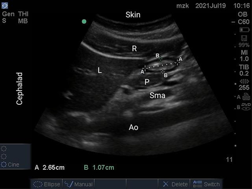 Figure 1 Upper abdominal sonographic image showing an empty stomach antrum. Antrum is pointed out by 4 x’s corresponding to its 2 perpendicular diameters.