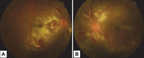 Figure 1 Clinical fundus photo of a 44-year-old male presenting with diminution of vision following dengue fever. (A) Right eye. (B) Left eye. Both eyes depicting perivascular exudates, intraretinal hemorrhages, cotton wool spots and macular edema. (A) Right eye showing additional retinal whitening exclusively inferior to the right macula.