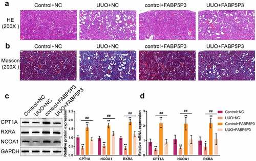 Figure 8. FABP5P3 alleviates the renal fibrosis of Unilateral Ureteral Obstruction (UUO) mice model Mice were treated with an intrarenal parenchymal injection of either FABP5P3-overexpressing or empty lentivirus 2 days before UUO. Two weeks after UUO. (a) the histopathological features of renal tissues were determined by H&E staining; (b) Masson’s trichrome staining was used for fibrosis analysis; (c) the protein levels of CPT1A, NCOA1, and RXRA in tissues were determined by Immunoblotting; (d) the mRNA levels of CPT1A, NCOA1, and RXRA in tissues were determined by real-time PCR. n = 9, *P <0.05, **P <0.01, compared to Control+NC group; ##P <0.01, compared UUO+NC with FABP5P3+NC group.