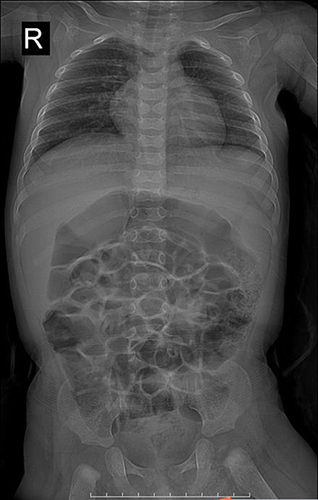Figure 1 Butterfly vertebrae seen in the thoracic region in children with Alagille syndrome (arrow showed).