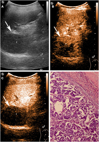 Figure 2 Splenic metastasis in a 53-year-old female patient. (A) B-mode US shows a normal-sized spleen with 4.5 cm in diameter inhomogeneous hypoechoic lesion (arrow) with almost regular shape. (B) CEUS shows heterogeneously iso-enhancing (arrow) lesion with some small nonenhanced areas (23 seconds after contrast injection). (C) CEUS shows hypoenhanced lesion with dotted aspect (arrow), followed by rapid and complete wash out in parenchymal phase (97 seconds after contrast injection). (D) Photograph of corresponding pathologic specimen through hematoxylin-eosin staining (100 magnification).