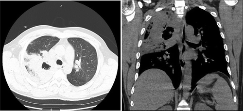 Figure 2. Chest CT without contrast showing right upper lobe cystic cavitation measuring approximately 3 cm in diameter. It also shows prominent precarinal and right hilar lymph nodes