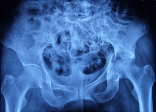 Figure 1 The anteroposterior radiograph shows acetabular fracture 25 days after the injury. (Type B, according to AO classification) with bilateral fractures of pubic ramus.Note: A 60-year-old woman suffered from acetabular fracture due to traffic accident.