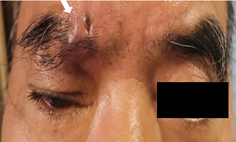 Figure 1 Clinical photo showed an irregular and lobulated mass lesion spanning across the right eyebrow region with a small depression and hyperpigmented area in the surface (white arrow).