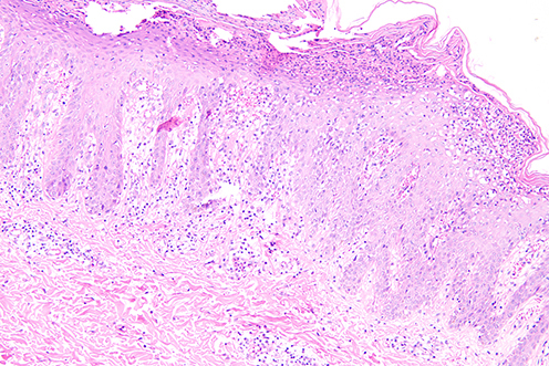Figure 2 Histopathology of ostraceous psoriasis, psoriasiform hyperplasia of the epidermis with confluent parakeratosis, neutrophils infiltration in the stratum corneum, and moderate amount lymphocyte and neutrophils around small vessels in the superficial dermis (Hematoxylin-eosin, magnification×100).