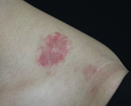 Figure 5 Nevus flammeus in patient with Fitzpatrick skin type III with permanent depigmentation after several sessions of pulsed dye laser (595 nm).