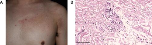 Figure 3 Skin lesions and histopathological results of patient 3. (A) Extensive erythematous infiltrative plaques and scattered papules on the left chest. (B) Dermis indicating dense infiltration with eosinophils and inflammatory cells (H&E, 100×).