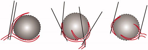 Figure 1. Schema of the needle puncture for PAE in HCC patients. The arterial punctual site was usually proposed on the lateral or posterior side of the tumour, away from the tumour centre. The arterial puncture was made at its largest segment with angle of 0–60 degrees between the needle and vessel. PAE: percutaneous artery embolisation.