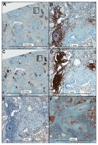 Figure 4 Immunohistochemistry of lung explant tissue for CD3 (A, B), CD20 (C, D), Ki-67 (E), and CD68 (F). The framed areas in the low magnification images for CD3 and CD20 are shown at higher magnification in the right panels (B and D, respectively). Ki-67, a marker of cellular proliferation, shows minimal positivity within the lymphocyte aggregates. The aggregates consist almost exclusively of T cells and B cells, with only a few CD68+ cells within the aggregates.