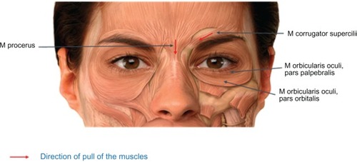 Figure 1 Muscles involved in glabellar frown lines. Reproduced with permission from Merz Pharmaceuticals GmbH.