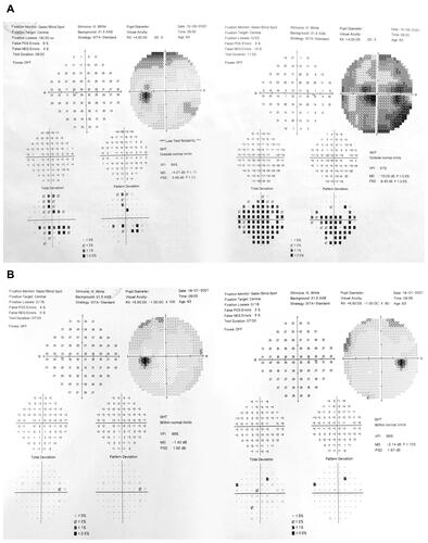 Figure 2 (A) Computed perimetry (visual field) at the end of pulse corticosteroid therapy-on the left eye (left side of figure) there is some sensitivity and pattern reduction (MD and PSD values); on the right eye (right side of figure) variables are still disturbed, but better than initial ones (described in the text): VFI 57%, mean defect (MD) is halved (−15.05 dB) and pattern deviation (PSD) is now differentiated into scotomas. (B) normalization of visual field, four months later, with residual slight reduction of sensitivity on the right eye (right side of figure).