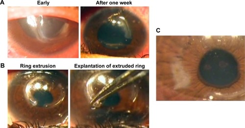 Figure 2 (A) Signs of infection in the presence of Kerarings. (B) Explantation of Keraring. (C) Postexplantation corneal scarring.