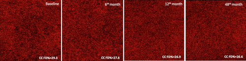 Figure 3 Choriocapillaris SS-OCTA scans in non-exudative fellow cCSC pachychoroid eye and continuously treated with eplerenone. Scans were acquired at baseline visit and 6 months, 12 months, and 48 months. The figure shows the CC FD % changes throughout the follow-up.