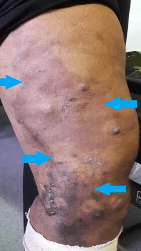 Figure 1 Cutaneous haemangioma seen on left thigh of a patient with Klippel-Trénaunay syndrome (limit of edges outlined by blue arrows).
