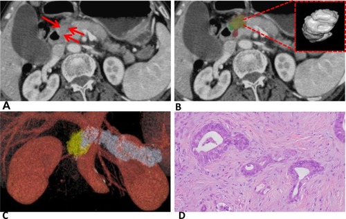 Figure 3 (A) Axial portal-phase contrast-enhanced CT of low-grade PDAC in a 63-year-old woman. Red arrows indicate the tumor. (B) Tumor segmentation. One observer segmented tumor in red and the other observer segmented tumor in green. The lime region indicates the overlapping region of two lesion masks. Segmentation indicated by the dashed red line. (C) Image reconstructed by AW VolumeShare 5. (D) H&E-stained specimen (200×) demonstrated disordered, well-differentiated duct-like structure, tumor cells were cubic and columnar with small nucleoli and uncommon nuclear division.