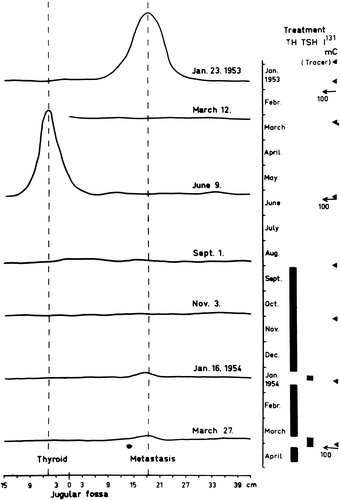 Figure 2.  Profile scanning of 131I uptake showing initial uptake over metastases in the mediastinum. After 131I treatment uptake in the thyroid rest is observed. After retreatment with 131I also the thyroid rest is ablated.