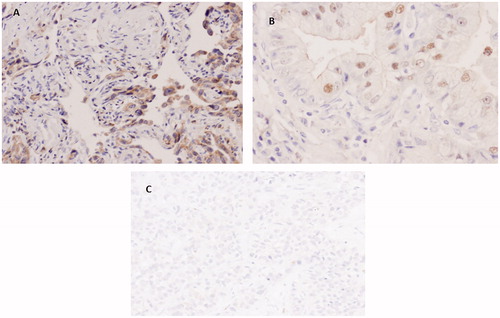 Figure 2. Immunohistochemical staining of PKP1 in AC. (A and B) Weak cytoplasmic and nuclear staining (40×). (C) Poorly differentiated AC with completely negative staining (10×).