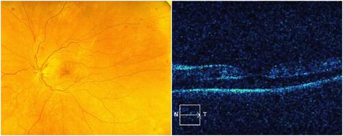 Figure 1 (Left) Fundus photo showing scattered dot blot hemorrhages. (Right) OCT contour map showing serous detachment but no overt cystic edema.